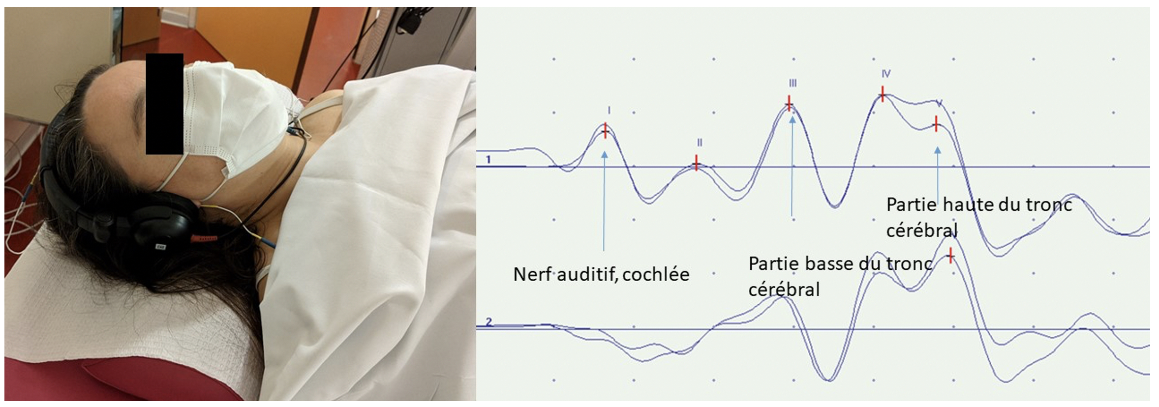Les Potentiels Evoques Auditifs Pea Snclf Societe De Neurophysiologie Clinique De Langue Francaise